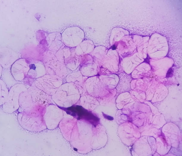 80+ Fotos, Bilder und lizenzfreie Bilder zu Atherom iStock