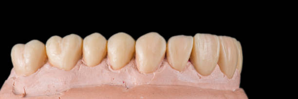 istock Emax ceramic crowns and veneers like natural teeth 1484926218