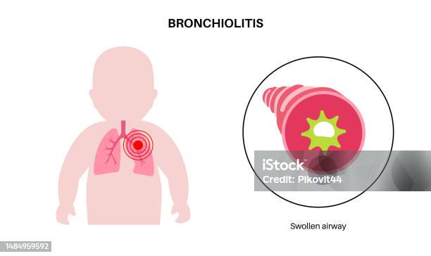 Broncholite Bronchiolitis Lung Disease Stock Illustration - Download Image Now ...