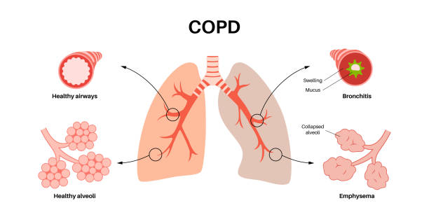 Copd Draw 780+ Lung Copd Stock Illustrations, Royalty-Free Vector Graphics & Clip ...