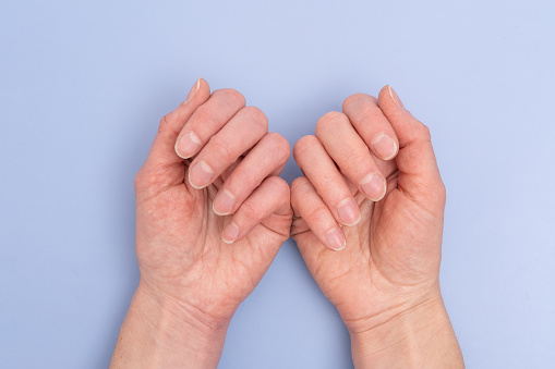 Close-up of two female hands with natural nails, overgrown cuticle on a blue background, top view, copy space. hand and nail care. The concept of health, self-care