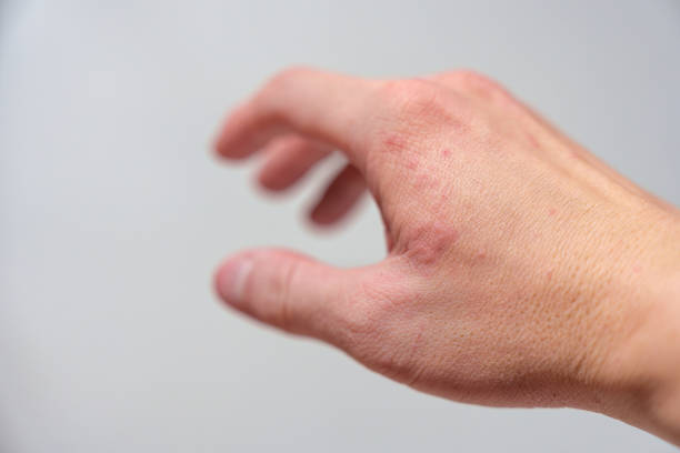 istock Allergic reaction, Red rash itychy on hand 1485133250