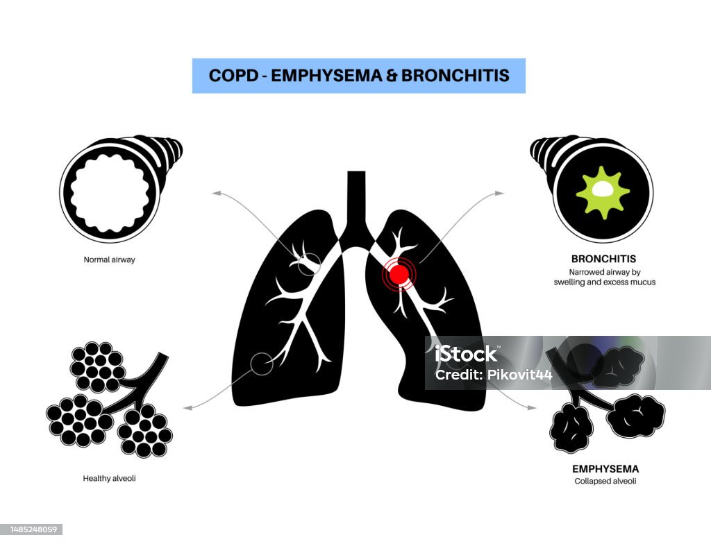 Copd Background Chronic Obstructive Pulmonary Disease Stock Illustration - Download ...