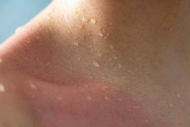 istock Hot water burns and water droplets on the body 1485587936