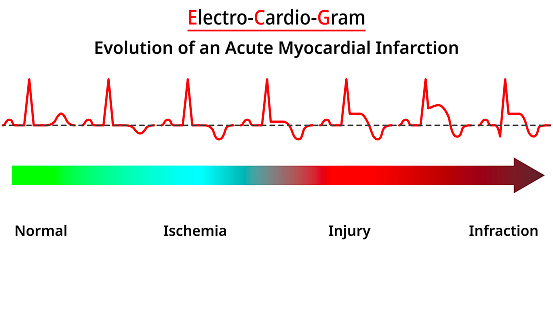 Atrial Infarction Evolution Of An Acute Myocardial Infarction Stock Illustration ...