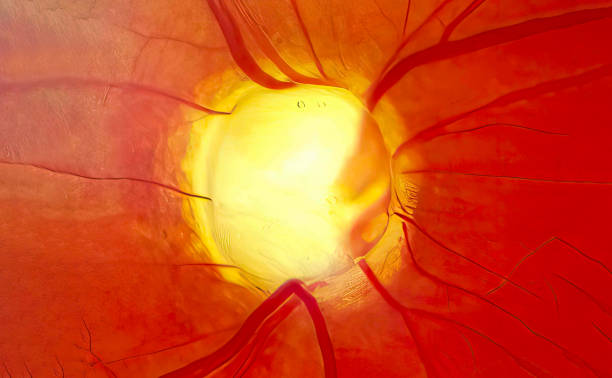 Optic nerve in advanced glaucoma disease Optic nerve in advanced glaucoma disease atrophy stock pictures, royalty-free photos & images