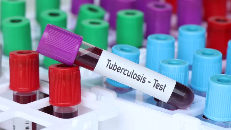 Tb Testing Lab 130+ Tuberculosis Cells Stock Videos and Royalty-Free Footage - iStock