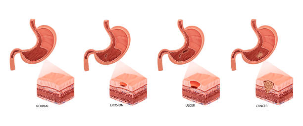 illustrazioni stock, clip art, cartoni animati e icone di tendenza di malattie dello stomaco. diagramma delle malattie gastrite, erosione, ulcera e cancro. illustrazione vettoriale anatomica educativa - piloro