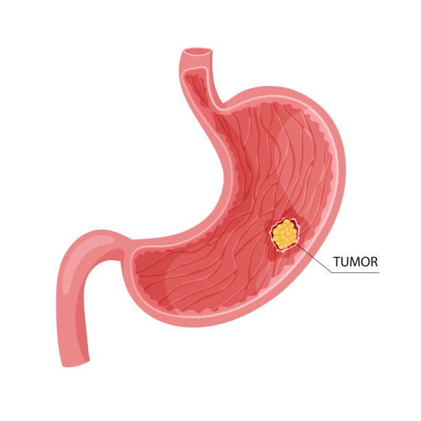 istock Stomach cancer. Malignant cancerous tumor. Anatomical vector illustration isolated white background cartoon style 1485734118