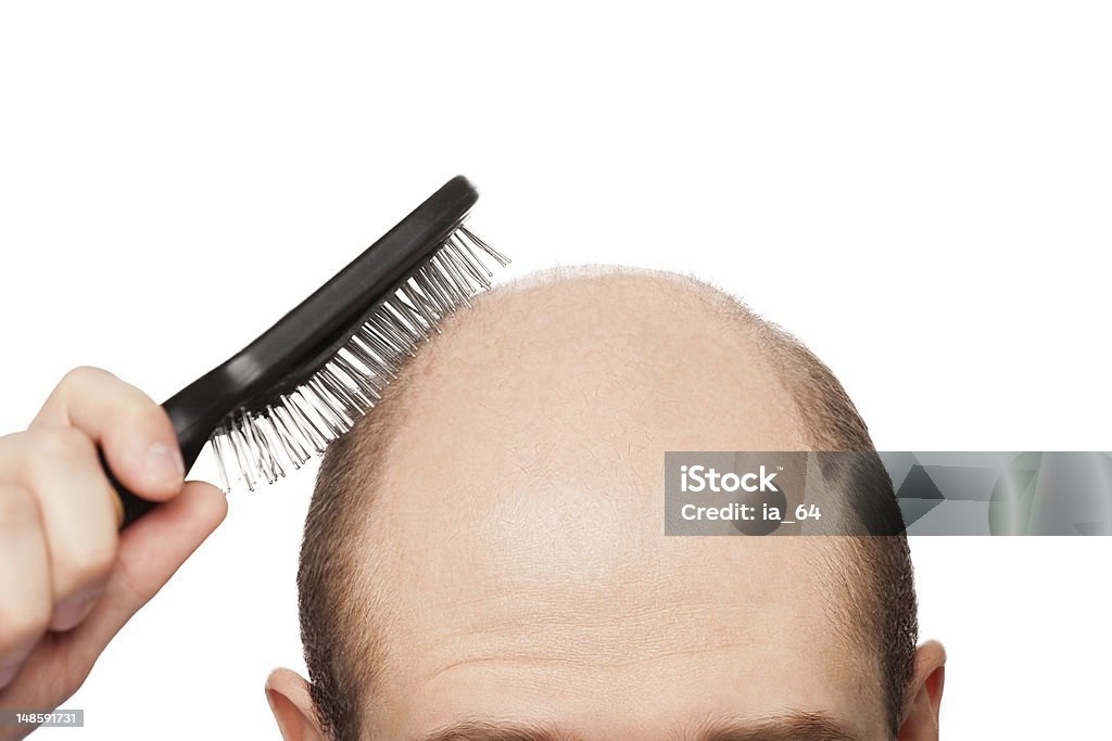 Bald man head Human alopecia or hair loss - adult man hand holding comb on bald head Completely Bald Stock Photo