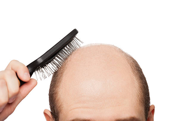 Bald man head Human alopecia or hair loss - adult man hand holding comb on bald head Combing stock pictures, royalty-free photos & images