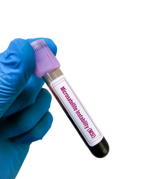 istock Microsatellite Instability (MSI) test, MSI screening is used to see the function of Lynch syndrome genes, Hereditary Colorectal Cancer. DNA mismatch repair. 1485940835