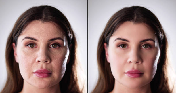 istock Before After Young Girl Face Wrinkle 1485963125