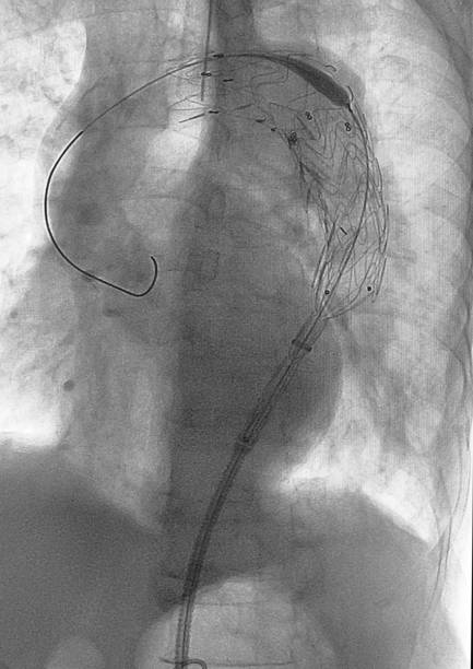 istock Endovascular aneurysm repair procedure 1486087262