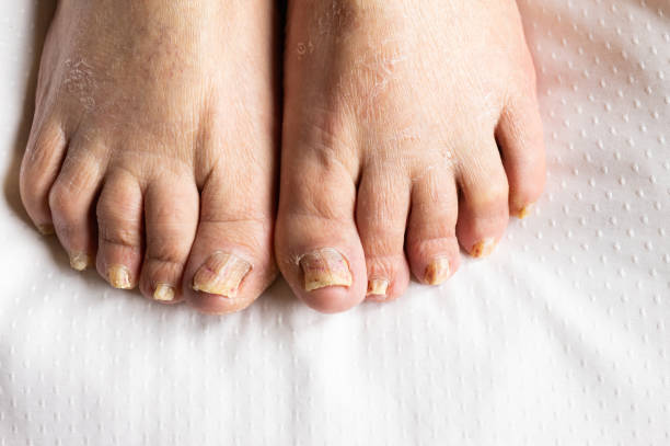 woman,s feet with long nails infected by fungus and psoriasis. toenails woman,s feet with long nails infected by fungus and psoriasis. toenails trichophyton fungus stock pictures, royalty-free photos & images