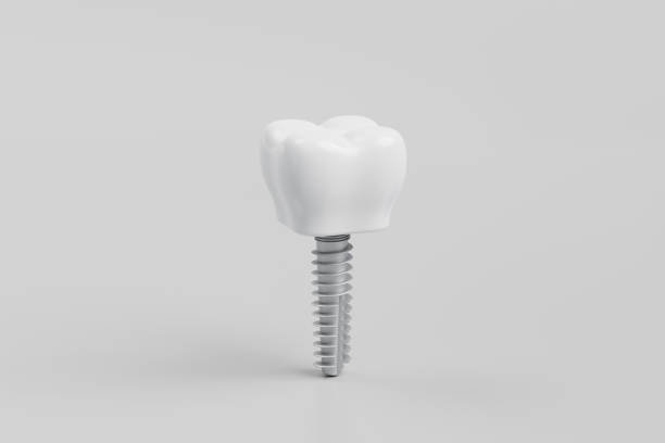 istock tooth implant on a gray background. 3d render. 1486299056