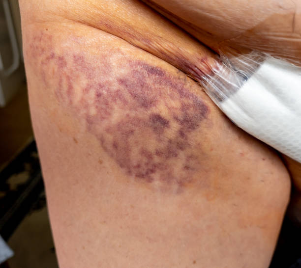 istock Bruising, contusion on the leg around the open wound after surgery. 1486486812