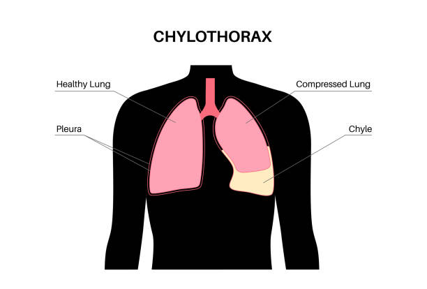 chylothorax anatomisches poster - inhaling human lung problems anatomy stock-grafiken, -clipart, -cartoons und -symbole