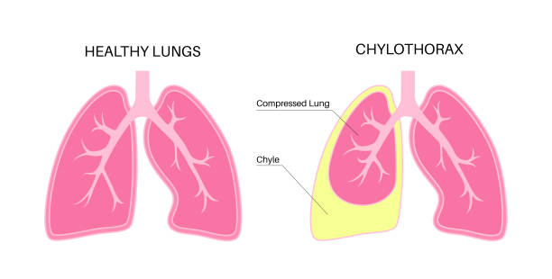 chylothorax anatomisches poster - inhaling human lung problems anatomy stock-grafiken, -clipart, -cartoons und -symbole