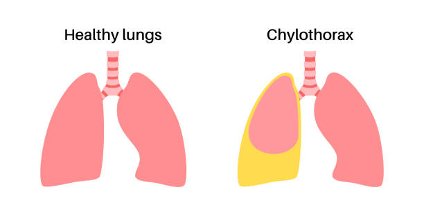 chylothorax anatomisches poster - inhaling human lung problems anatomy stock-grafiken, -clipart, -cartoons und -symbole