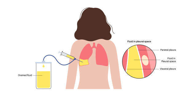 medizinisches verfahren der thorakozentese - inhaling human lung problems anatomy stock-grafiken, -clipart, -cartoons und -symbole