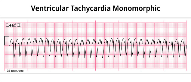 Monomorphic Ventricular Tachycardia (MVT) ECG – Monomorphic VT - 8 Second Electrocardiogram Paper - Vectors and Illustrations for Medical Purposes