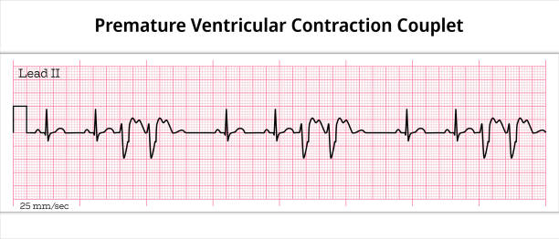 couplet vorzeitige ventrikuläre kontraktionen (pvcs) - ventrikulärer vorzeitiger schlag - ves - 8-sekunden-ekg-papier - elektrokardiogramm - herzkammer stock-grafiken, -clipart, -cartoons und -symbole