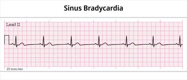 Vector illustration of Sinus Bradycardia ECG - 8 Second ECG Paper