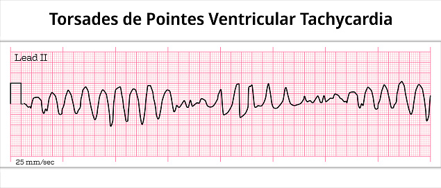 Torsades de Pointes Ventricular Tachycardia ECG - 8 Second Electrocardiogram Paper - Vectors and Illustrations for Medical Purposes
