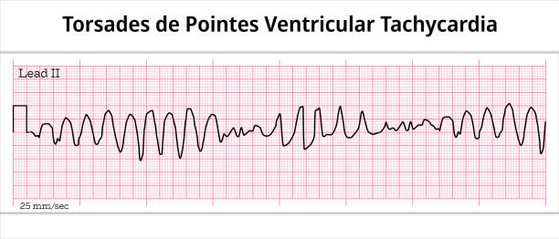 Torsades de Pointes Ventricular Tachycardia ECG - 8 Second Electrocardiogram Paper Torsades de Pointes Ventricular Tachycardia ECG - 8 Second Electrocardiogram Paper - Vectors and Illustrations for Medical Purposes heart ventricle stock illustrations