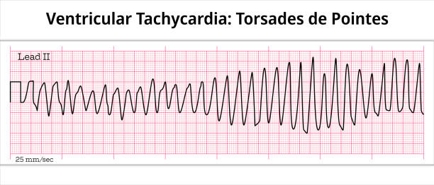 istock ECGTorsades de Pointes Ventricular Tachycardia (VT) - 8 Second Electrocardiogram Paper 1486696172