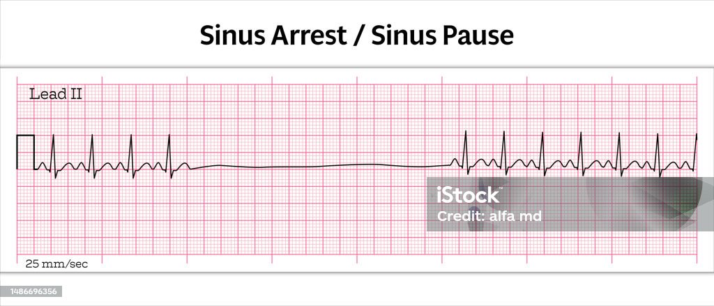 Ecg Sinus Arrest Sinus Pause 8 Second Electrocardiogram Paper Vecteurs ...