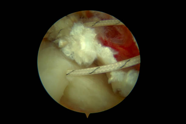 istock Rotator cuff repair in the right shoulder 1486796232