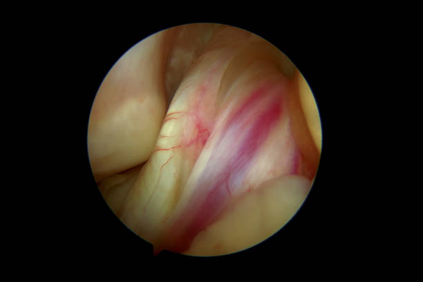 Arthroscopic view of the normal looking anterior cruciate ligament (ACL) of the right knee of an adult human male Arthroscopic view of the right human knee in about 45 degrees of flexion during an arthroscopic examination by an orthopaedic surgeon at a day-surgery center. The anterior cruciate ligament (ACL) consists of two major fibre bundles, namely the anteromedial (to the right) and posterolateral (to the left) bundles. When the knee is extended, the posterolateral bundle (PL) is tight and the anteromedial (AM) bundle is moderately lax. As the knee is flexed, the AM bundle tightens and the PL bundle relaxes. The AM bundle is the primary restraint against anterior tibial translation, whereas the PM bundle tends to stabilize the knee near full extension, and particularly against rotatory loads. Injury (tear or rupture) of the ACL is a common injury, especially in sports with rapid pivoting movements such as European team handball and soccer. A torn ACL may lead to giving-way episodes. To regain the ability to do sporting activities, an ACL reconstruction procedure is often warranted (using a graft secured close to the anatomic origins of the native ACL). The image was captured with a 4mm 30 degrees arthroscope. posterior cruciate ligament stock pictures, royalty-free photos & images