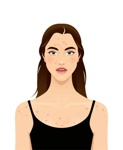 Vector illustration of Acne