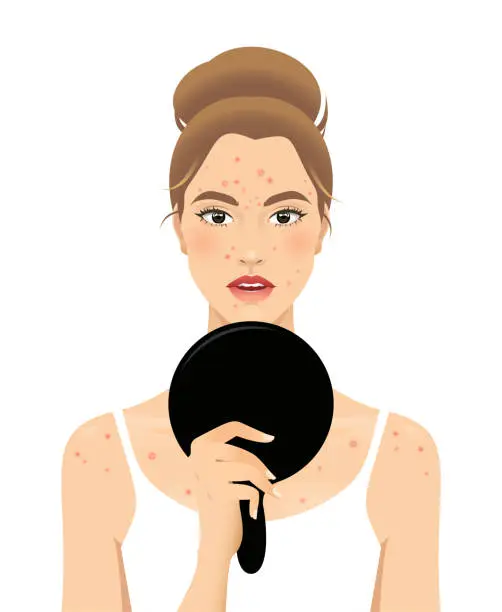Vector illustration of Young woman with acne