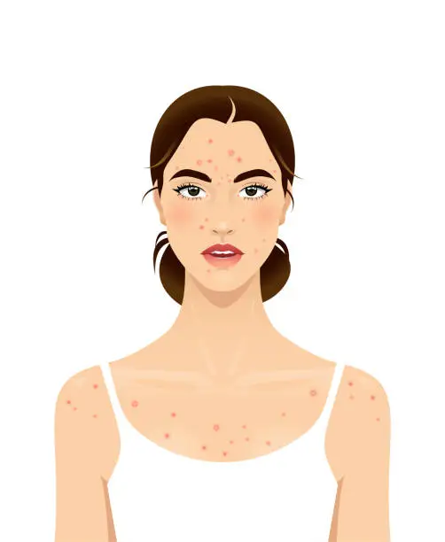 Vector illustration of Young woman with acne