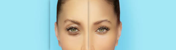 istock Lower and upper Blepharoplasty.plastic surgery concept. 1486903161