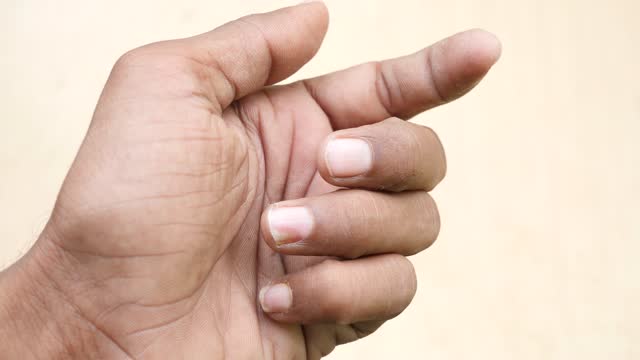 Nail psoriasis on finger , slow motion sgit