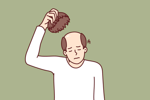 ilustrações, clipart, desenhos animados e ícones de homem tira peruca e experimenta estresse da calvície causada por problemas com o cabelo - alopecia homem