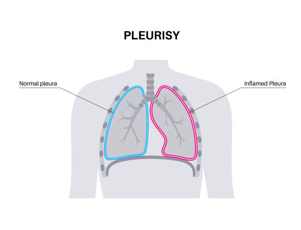 ilustrações, clipart, desenhos animados e ícones de doenças inflamatórias da pleurisia - inhaling human lung problems anatomy