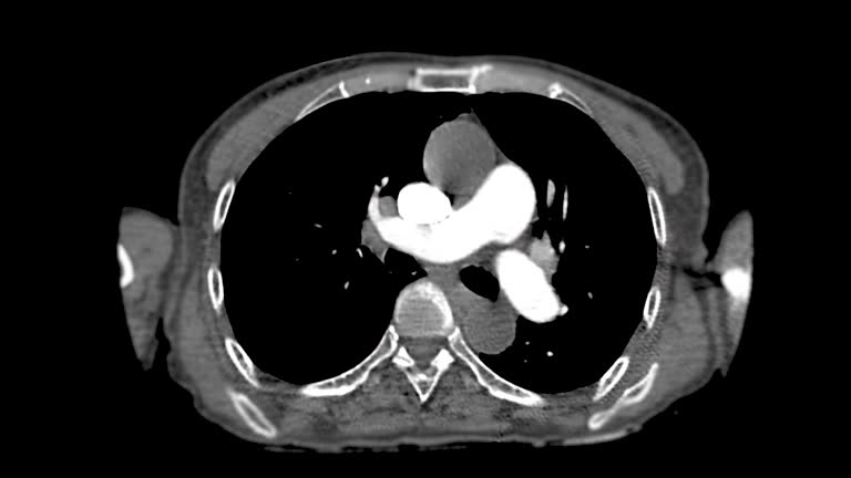 CTA pulmonary artery .