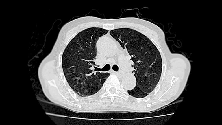 CT Scan of  Lung .