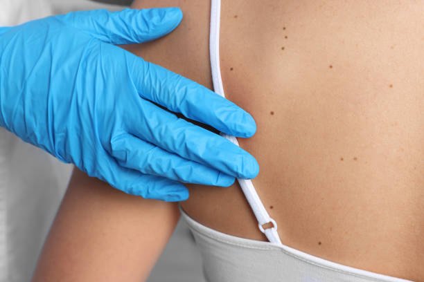 istock Dermatologist examining patient's birthmark in clinic, closeup 1487290231