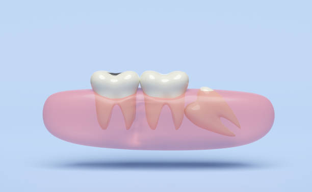 istock 3d wisdom teeth model problems icon with gums isolated on blue background. dental examination of the dentist, health of white teeth, oral care, 3d render illustration 1487292575