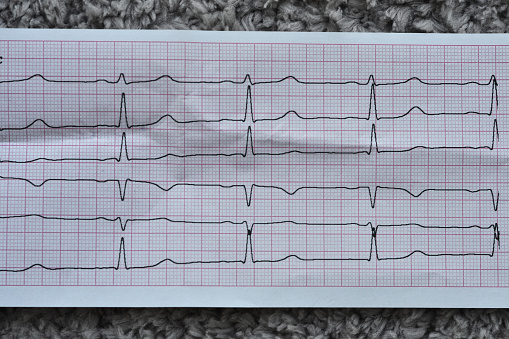 ECG ElectroCardioGraph paper that shows Normal Sinus Rhythm NSR with frequent PACs Premature Atrial Contractions, PVCs Premature Ventricular Contractions, lateral ST-T abnormality, myocardial ischemia, selective focus