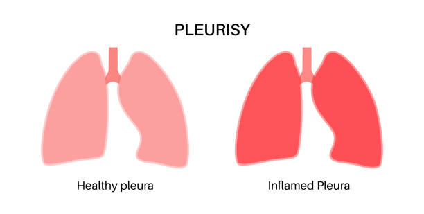 pleuritis-entzündungskrankheiten - inhaling human lung problems anatomy stock-grafiken, -clipart, -cartoons und -symbole