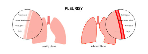 pleuritis-entzündungskrankheiten - inhaling human lung problems anatomy stock-grafiken, -clipart, -cartoons und -symbole