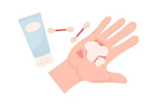 Vector illustration of Hand Injuries Treatment With Special Cream