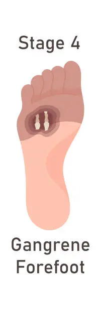 Vector illustration of Gangrene Forefoot Disease